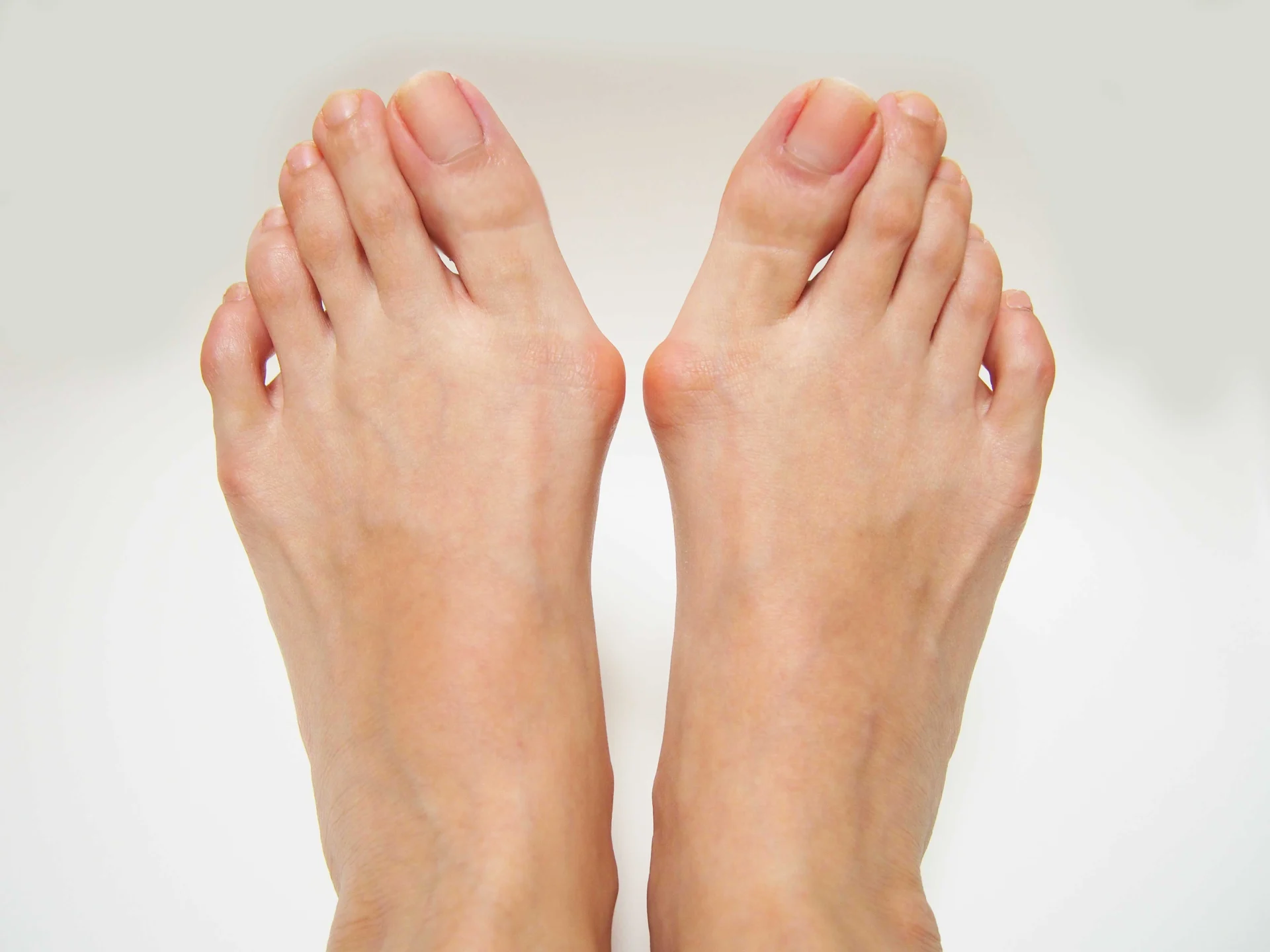 Bunions are well managed with a minimally invasive technique. Smaller incisions, less pain, earlier recovery.